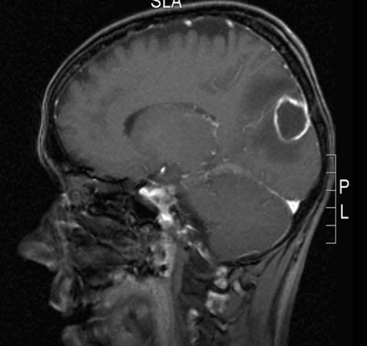 hjerneabscess 2 hjerneabscess 2
