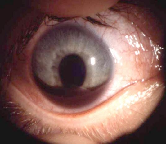 Blødning i øyet etter stump skade