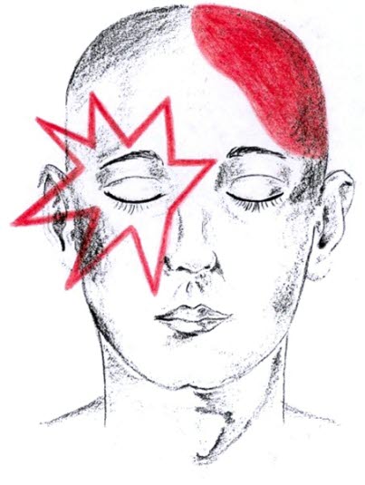 Hodepine - migrene, frontalt Hodepine - migrene, frontalt