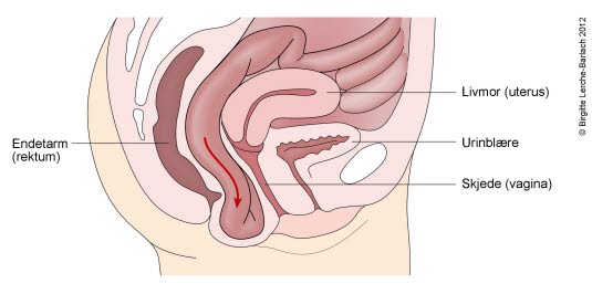 Enterocele Enterocele