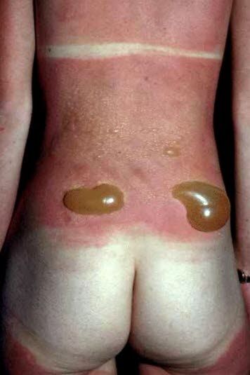 Fototoksisk erytem med væskefylte blemmer.