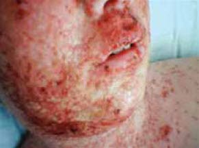 Uttalt tilfelle med vesikler og kruster som dekker pasientens ansikt og hals.