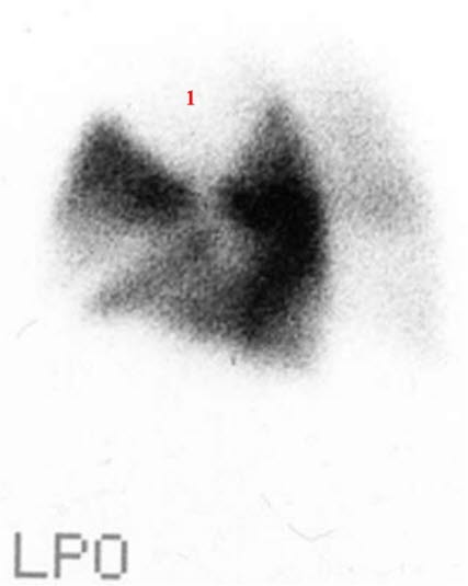 Lungeemboli, scintigrafi Lungeemboli, scintigrafi