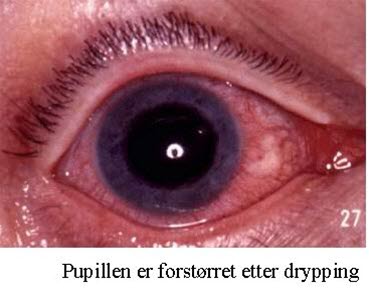 Iridosyklitt bilde#2