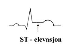 Hevet ST-segment