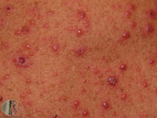 Vannkopper, nærbilde