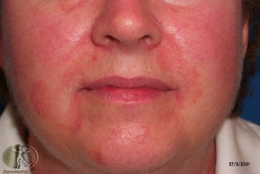 Seboroisk eksem, ansikt