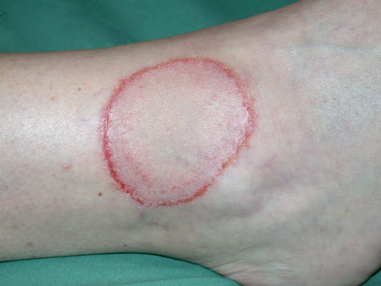 Tinea corporis