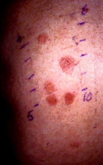 Positiv test for kontaktallergi mot enkelte planter. Papler og vesikler ved kraftig positiv reaksjon.