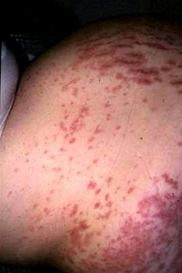 Polymorft svangerskapsutslett er en selvhelbredende tilstand som oppstår i slutten av svangerskap og presenterer seg som kløende papler og plakk.