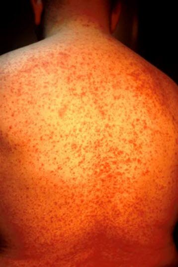 Legemiddelreaksjon 1