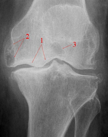Alvorlig slitasjegikt i kneet Alvorlig slitasjegikt i kneet