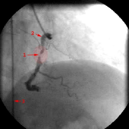 Stenose i høyre koronararterie