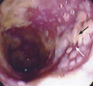 Typiske slimhinneforandringer.