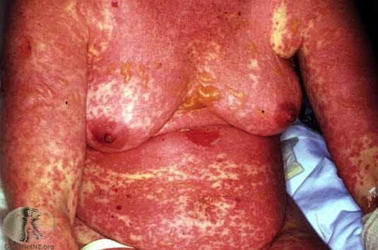 Toksisk epidermal nekrolyse