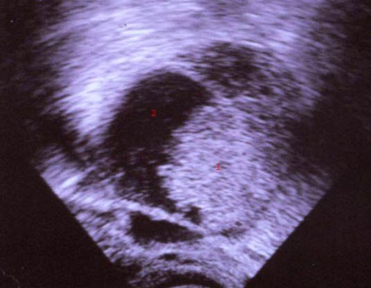 Endometroid adenocarcinom