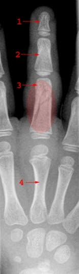 Fingerbrudd i innerste falang