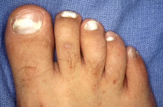 Her er alle neglene angrepet av neglsopp.