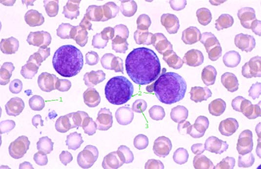 Illustrasjon: Umodne blodceller typisk ved blodkreft