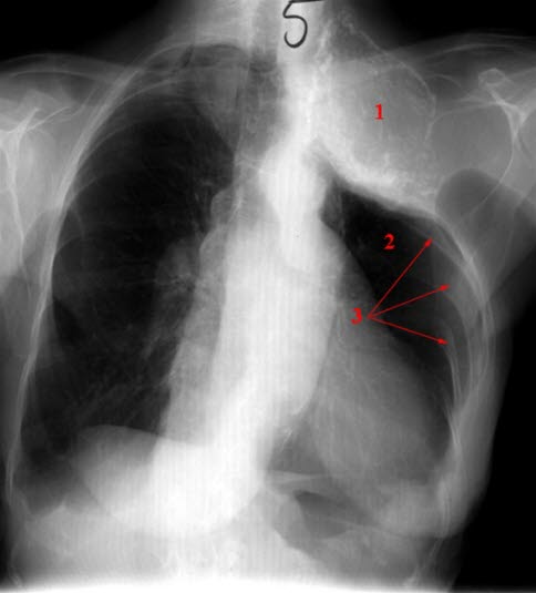 Torakoplastikk med oljeplombe Torakoplastikk med oljeplombe