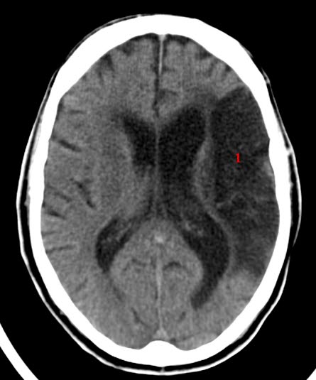 Cerebralt infarkt (CT)