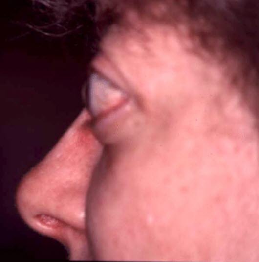 Exoftalmus, side Exoftalmus, side