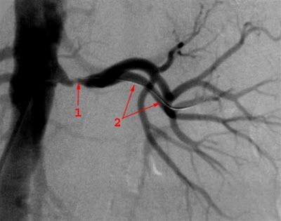 Nyrearteriestenose, kontrastrøntgen.