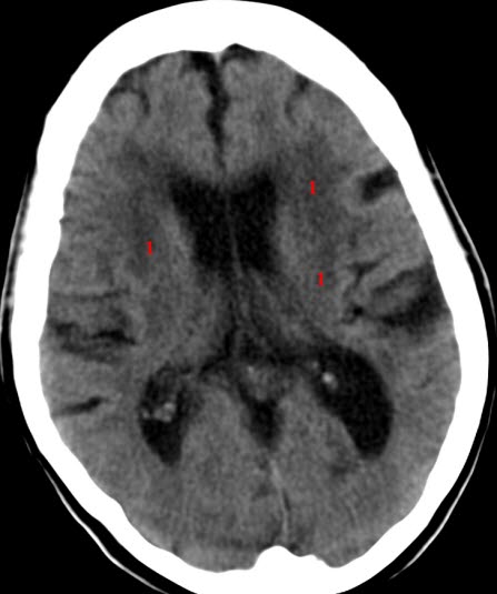 Cerebrale multiinfarkt (CT)