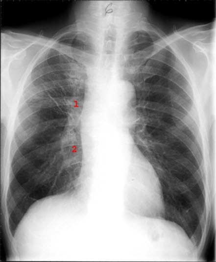Småcellet anaplastisk carcinom, etter behandling