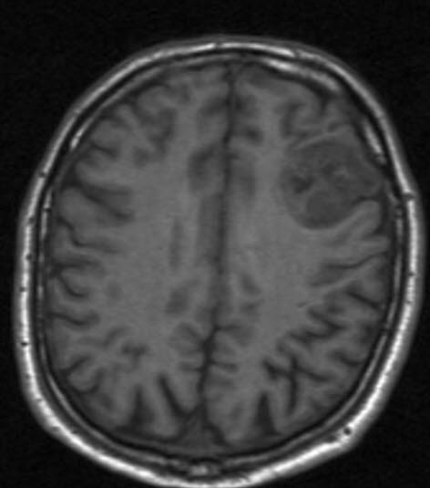 oligodendrogliom 1 oligodendrogliom 1