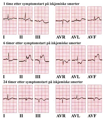 Infarkt - invertert T