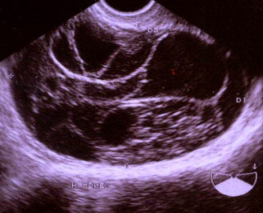 Mucinøst cystadenom (ultralydbilde)