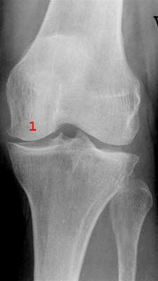 Gonartrose, lett Gonartrose, lett