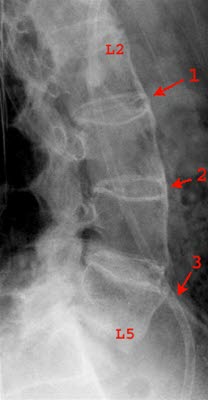 Røntgenbilde av forandringer i ryggen ved Bekhtrev