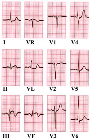 Nedreveggsinfarkt Nedreveggsinfarkt