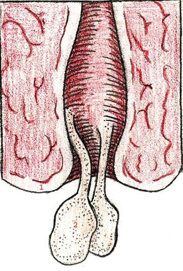 Polypper i livmorhalsen, lengdesnitt Polypper i livmorhalsen, lengdesnitt