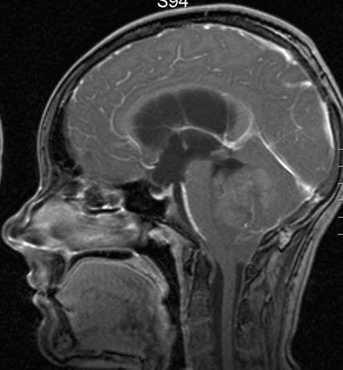 medulloblastom 2 medulloblastom 2