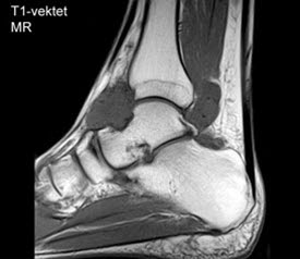 Osteokondromatose2 Osteokondromatose2