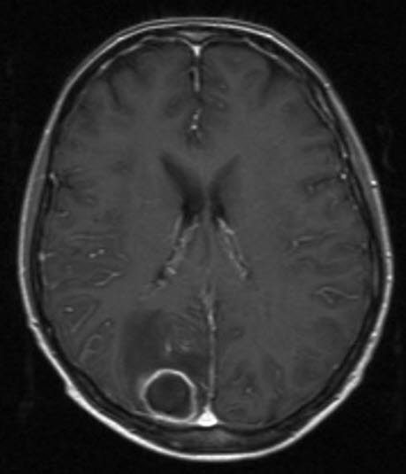 hjerneabscess 1 hjerneabscess 1