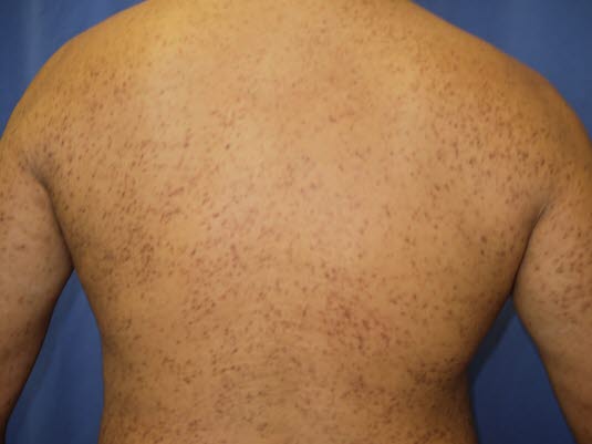 Urtikaria pigmentosa, kutan mastocytose. Urtikaria pigmentosa, kutan mastocytose.