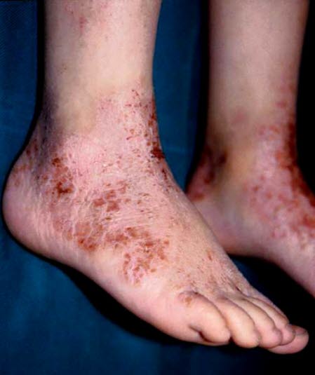 Atopisk eksem på fotryggen