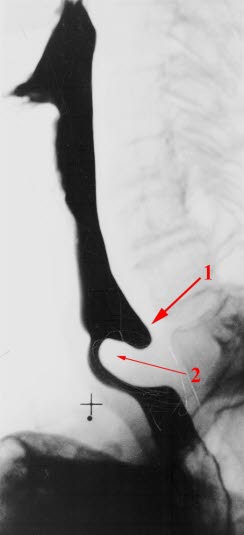 Zenkers divertikkel Zenkers divertikkel