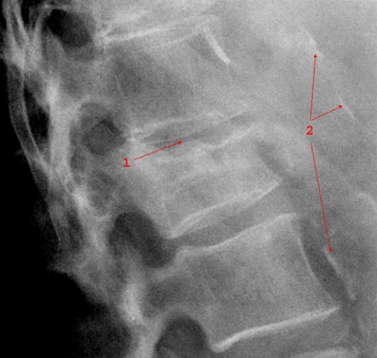 Røntgen av kompresjonsbrudd