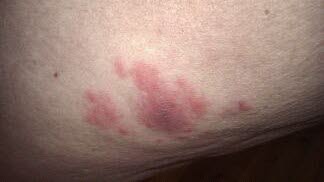 Atypisk utslett som kom 2-3 uker etter flåttbitt. Pasient var i starten usikker på om dette var erytema migrans, men det viste seg å være det i ettertid. Gjengitt med tillatelse fra Flåttsenteret Atypisk utslett som kom 2-3 uker etter flåttbitt. Pasient var i starten usikker på om dette var erytema migrans, men det viste seg å være det i ettertid. Gjengitt med tillatelse fra Flåttsenteret