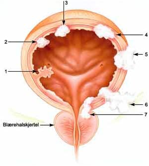 Svulster i urinblæren