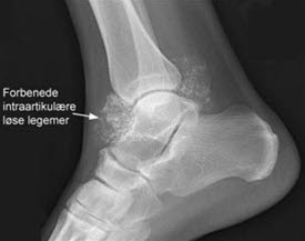 Osteokondromatose1 Osteokondromatose1