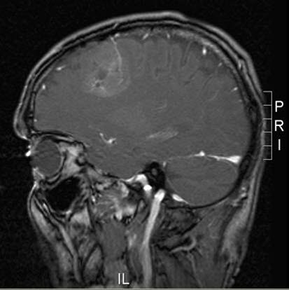 oligodendrogliom 3 oligodendrogliom 3