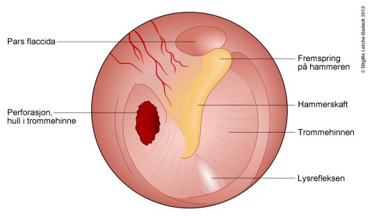 Sprukken trommehinne Sprukken trommehinne