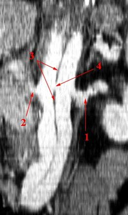 Aortadisseksjon (CT coronal rekonstruksjon)