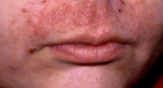 Papulo-vesikuløst utslett på leppe, her som følge av allergisk kontaktallergi mot Brulidine krem brukt mot munnsår.